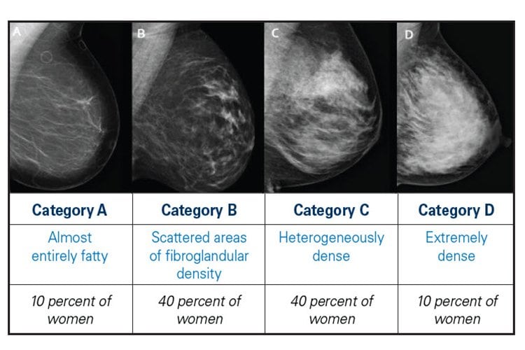 Photo of breast density imaging. From Left to Right first breast image, Category A reflects almost entirely fatty tissue which represent 10 per of women. Second,  breast image, Category B reflects scattered areas of fibroglandular density tissue which represents 40 percent of women. Third breast image, Category C reflects heterogeneously dense tissue which represents 40 percent of women. Fourth breast image, Category D reflects extremely dense tissue which represents 10 percent of women.  