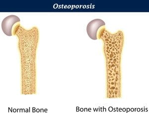 Osteoporosis - Normal Bone and Bone with Osteoporosis image.