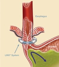 Photo of an esophagus with a LINX Refult Management System around it to prevent acid reflux.