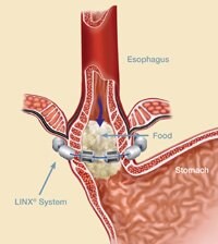 Photo of LINX around the Lower Esophageal Sphinctre (LES) allowing food to pass.