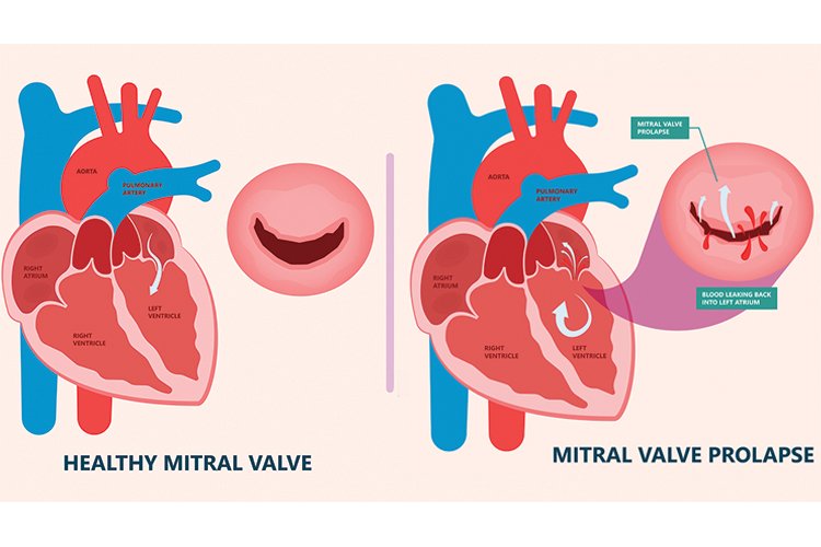 Photo of healthy hearts vs. heart with mitral valve prolapse